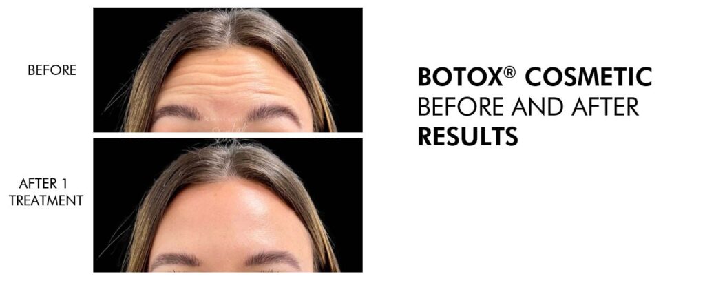 Botox treatment before and after 